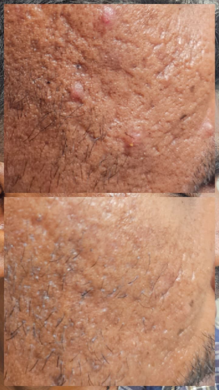 Acne Scar Treatment Result