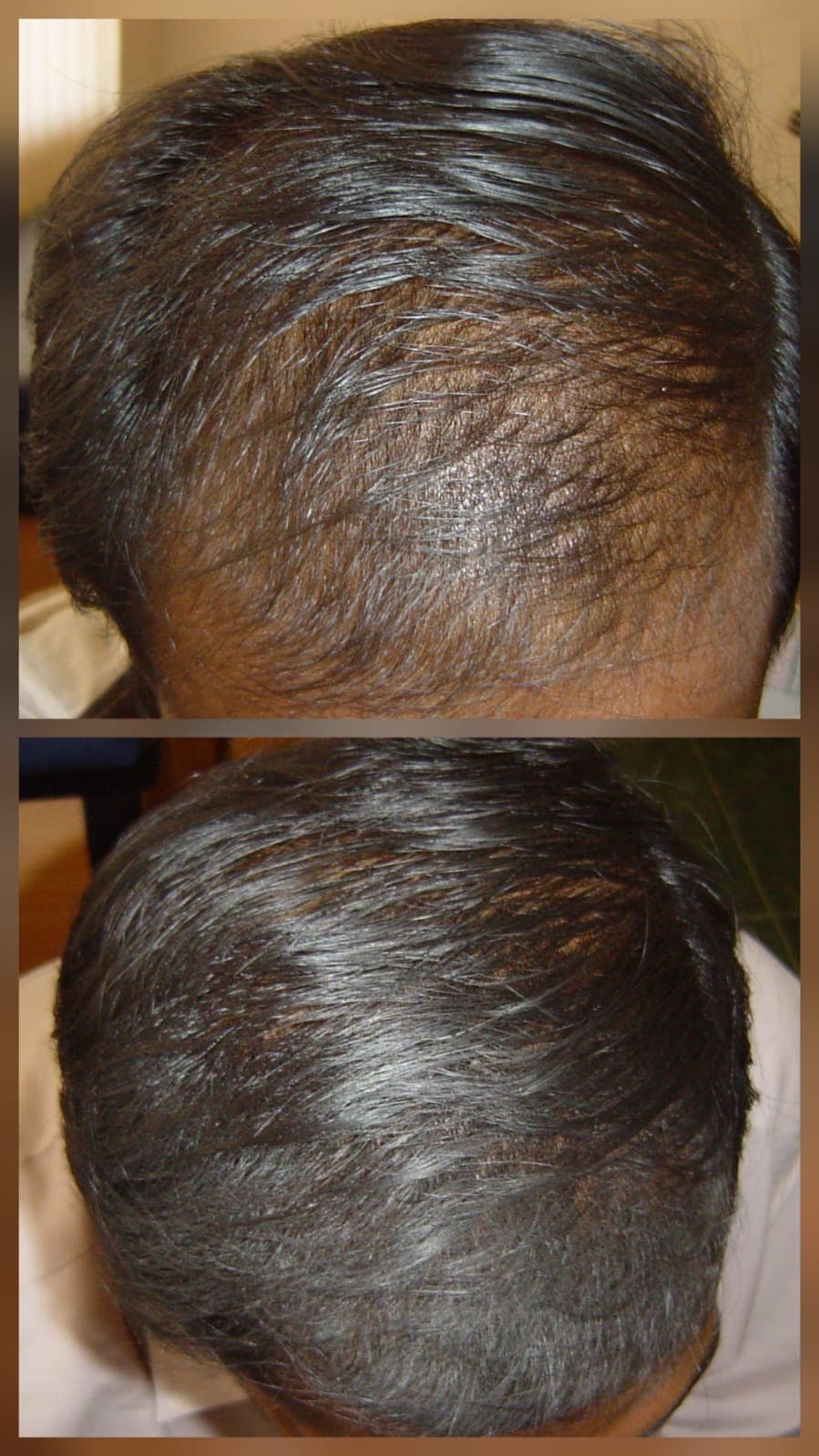 Hair Fall Treatment Result
